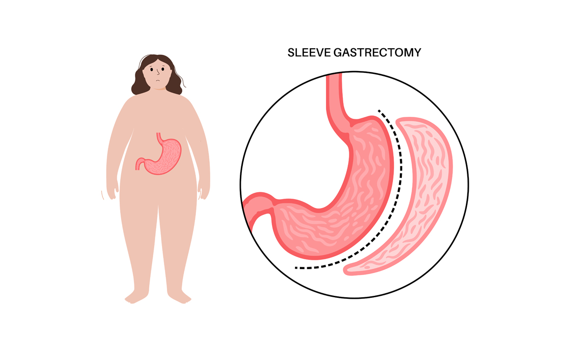 https://www.ahmetziyabalta.com/wp-content/uploads/2025/05/Sleeve-Gastrectomy.jpg